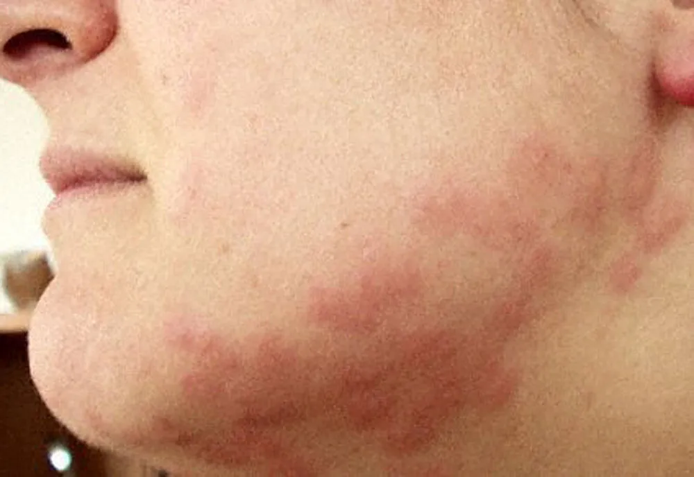 Bed Bug - photo 6