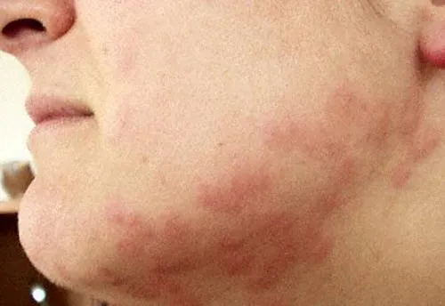 Bed Bug - photo 7